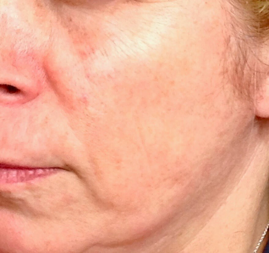 First Face Procedure Before First Face