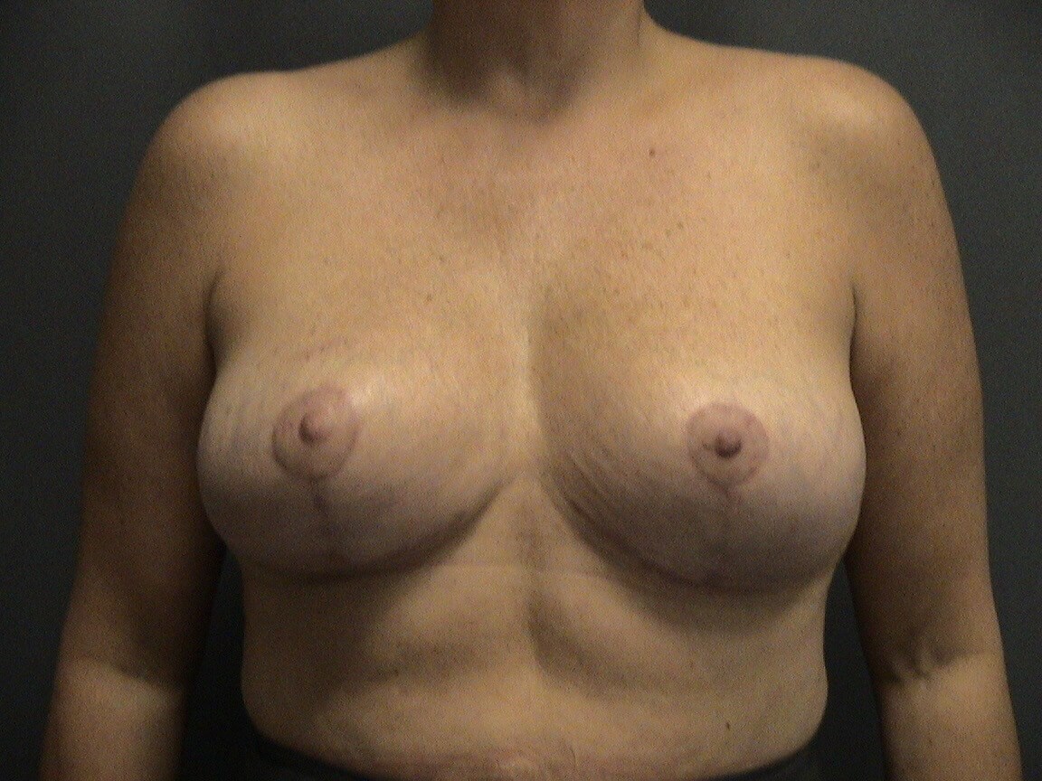 Breast Reduction After Breast Reduction